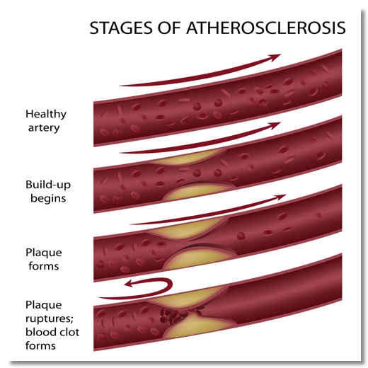 heart-disease